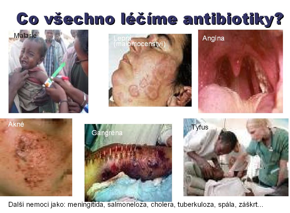 tyfus,gangrena....jpg